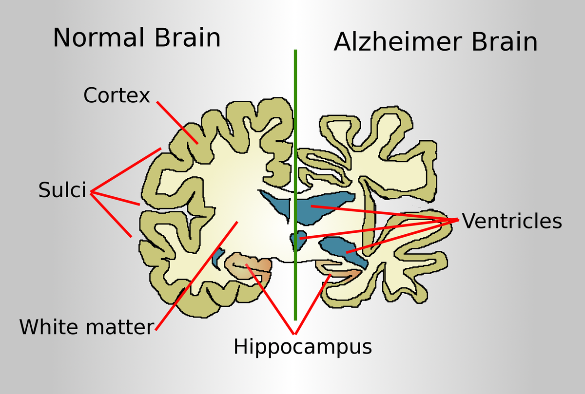مغز بیماران آلزایمری در مقایسه با افراد عادی