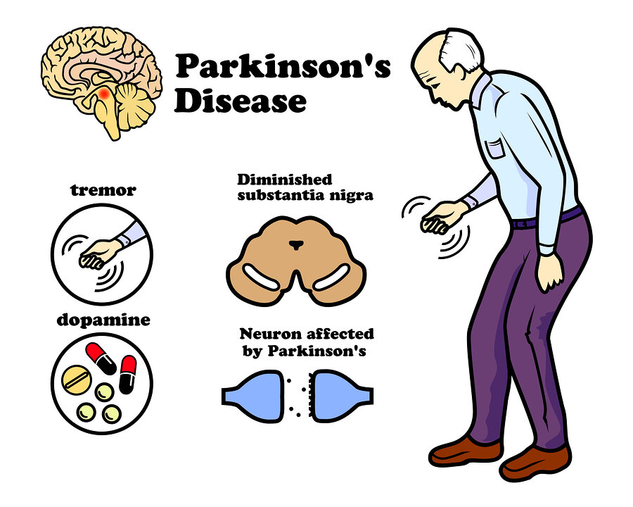 بیماری پارکینسون